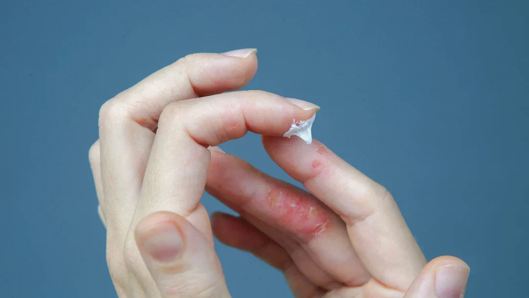 How to choose your cream for psoriasis?